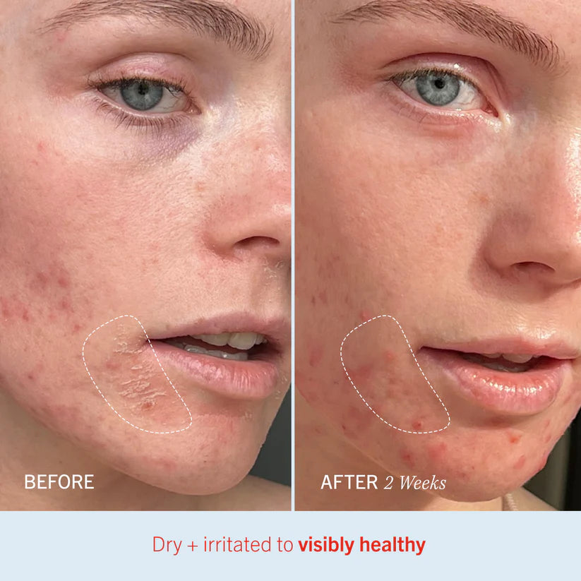 First Aid Beauty Ultra Repair® Cream Intense Hydration - Summit Beauty